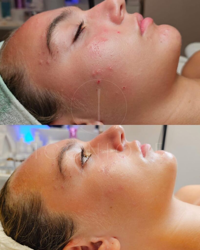 Risultato prima/dopo trattamento peeling chimico Iconique.