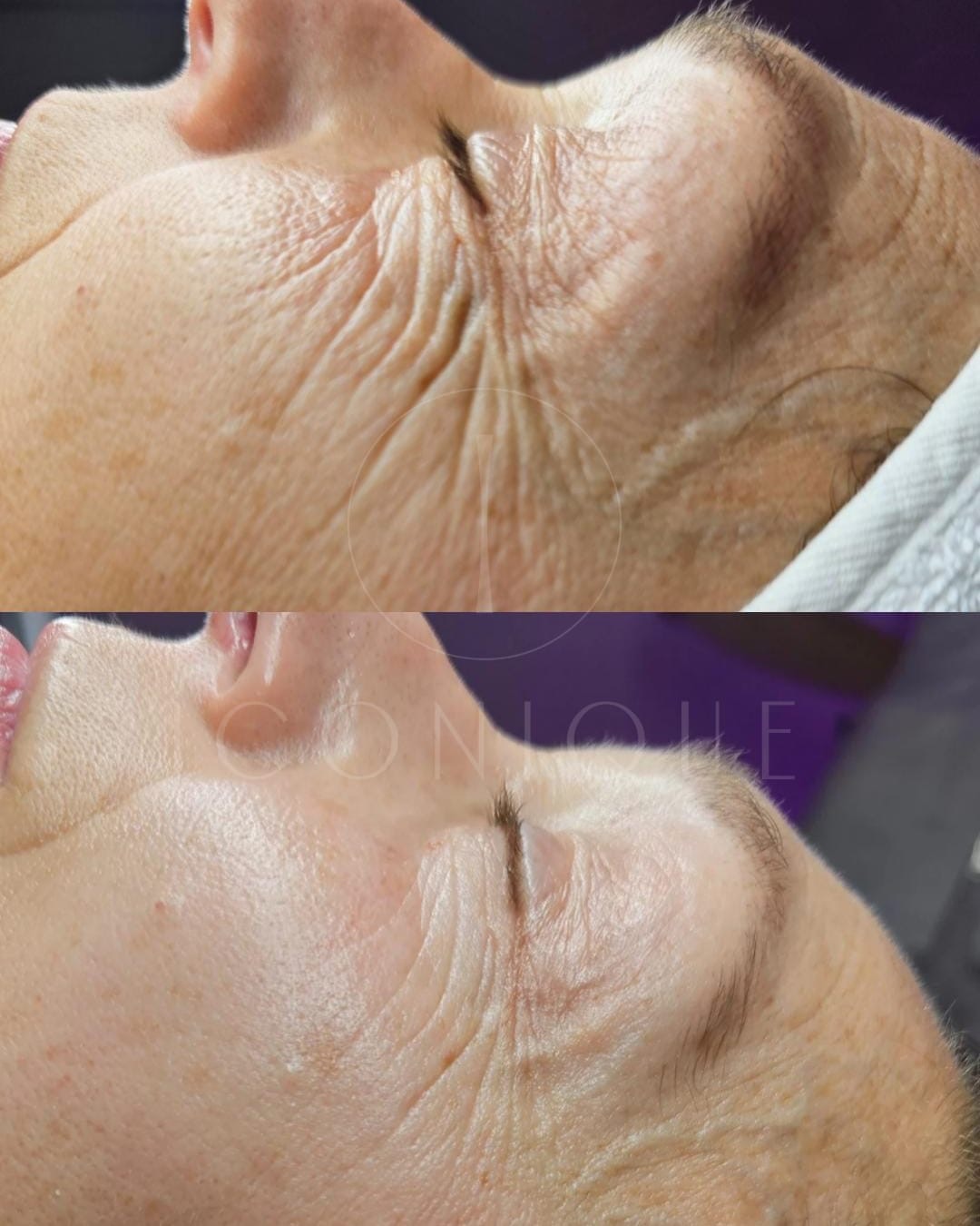 Risultato prima/dopo trattamento peeling chimico Iconique.