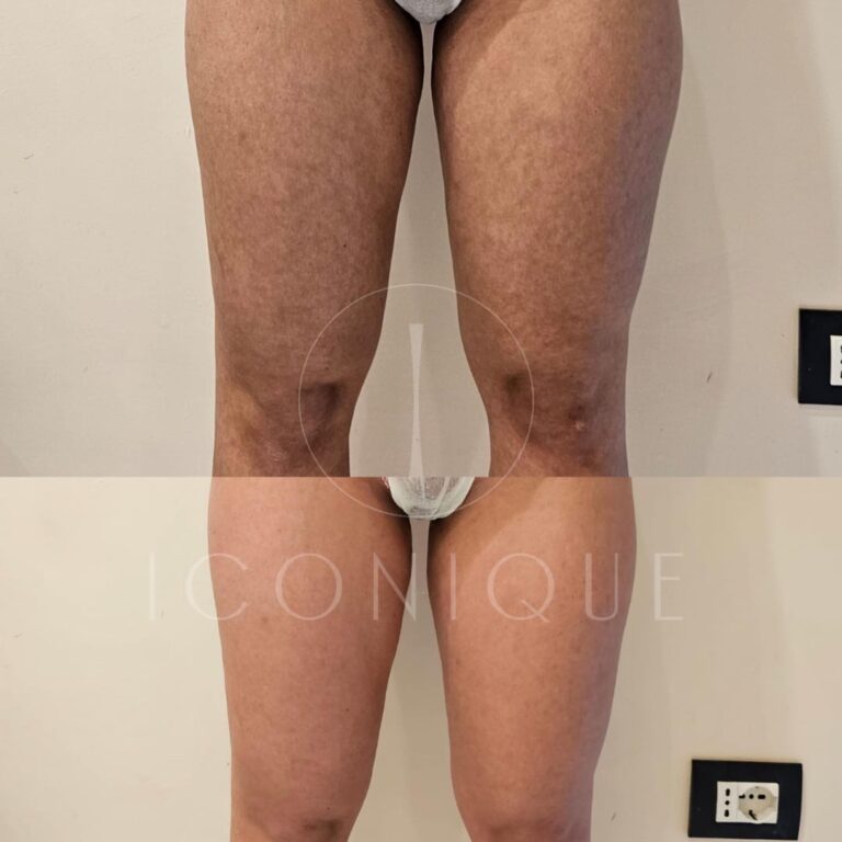 Risultato prima/dopo trattamento corpo Iconique