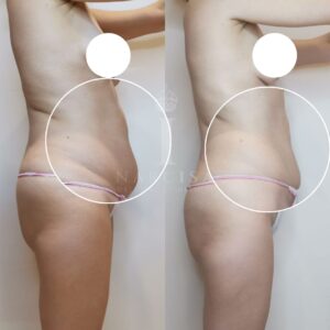 Risultato prima/dopo trattamento corpo Iconique.