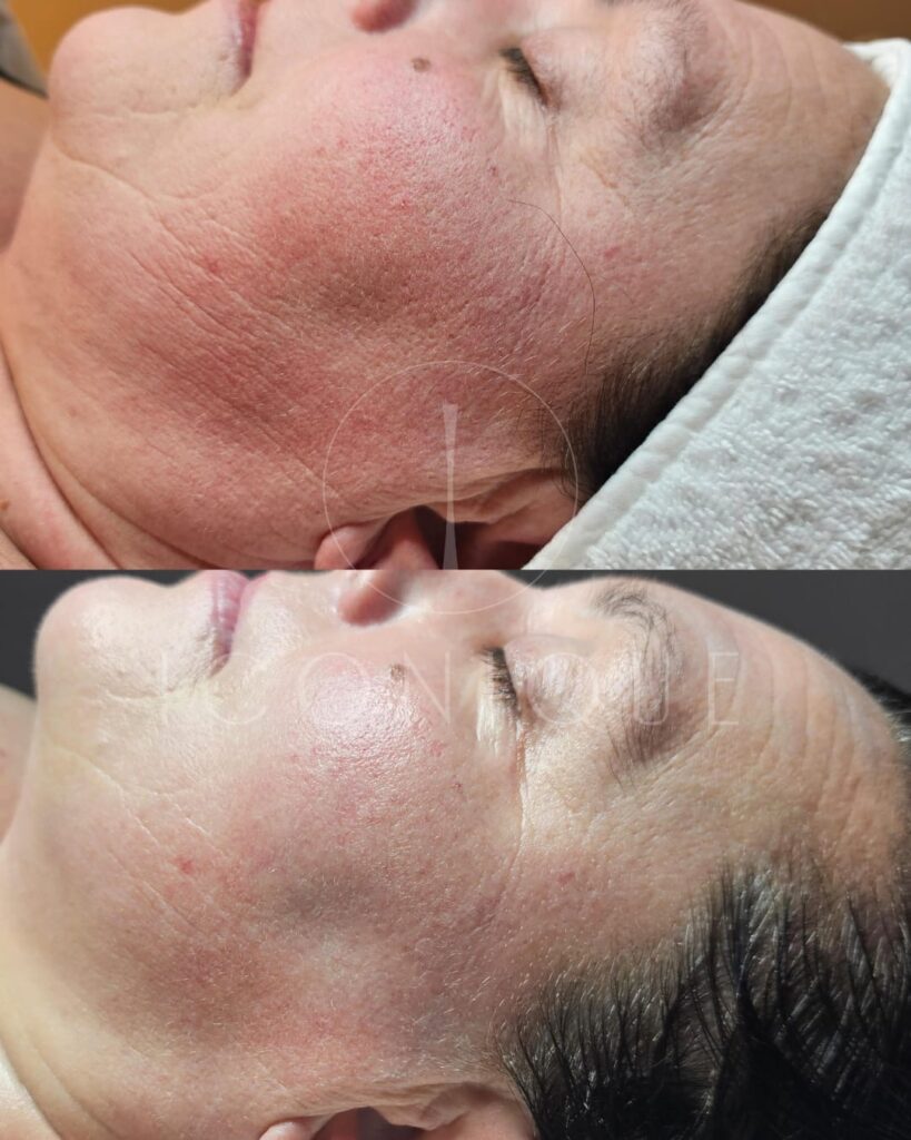 Risultato prima/dopo trattamento peeling chimico Iconique.