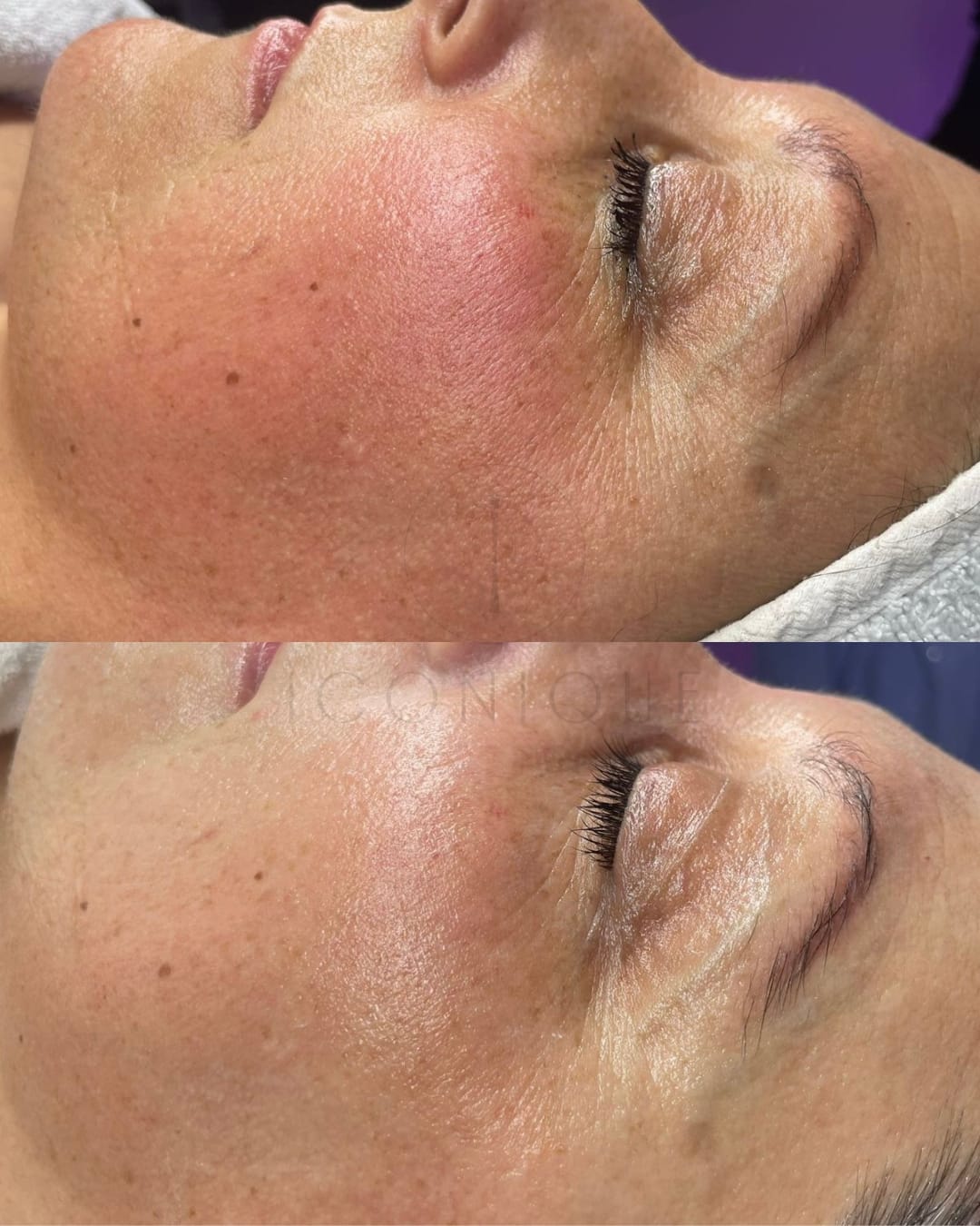 Risultato prima/dopo trattamento peeling chimico Iconique.