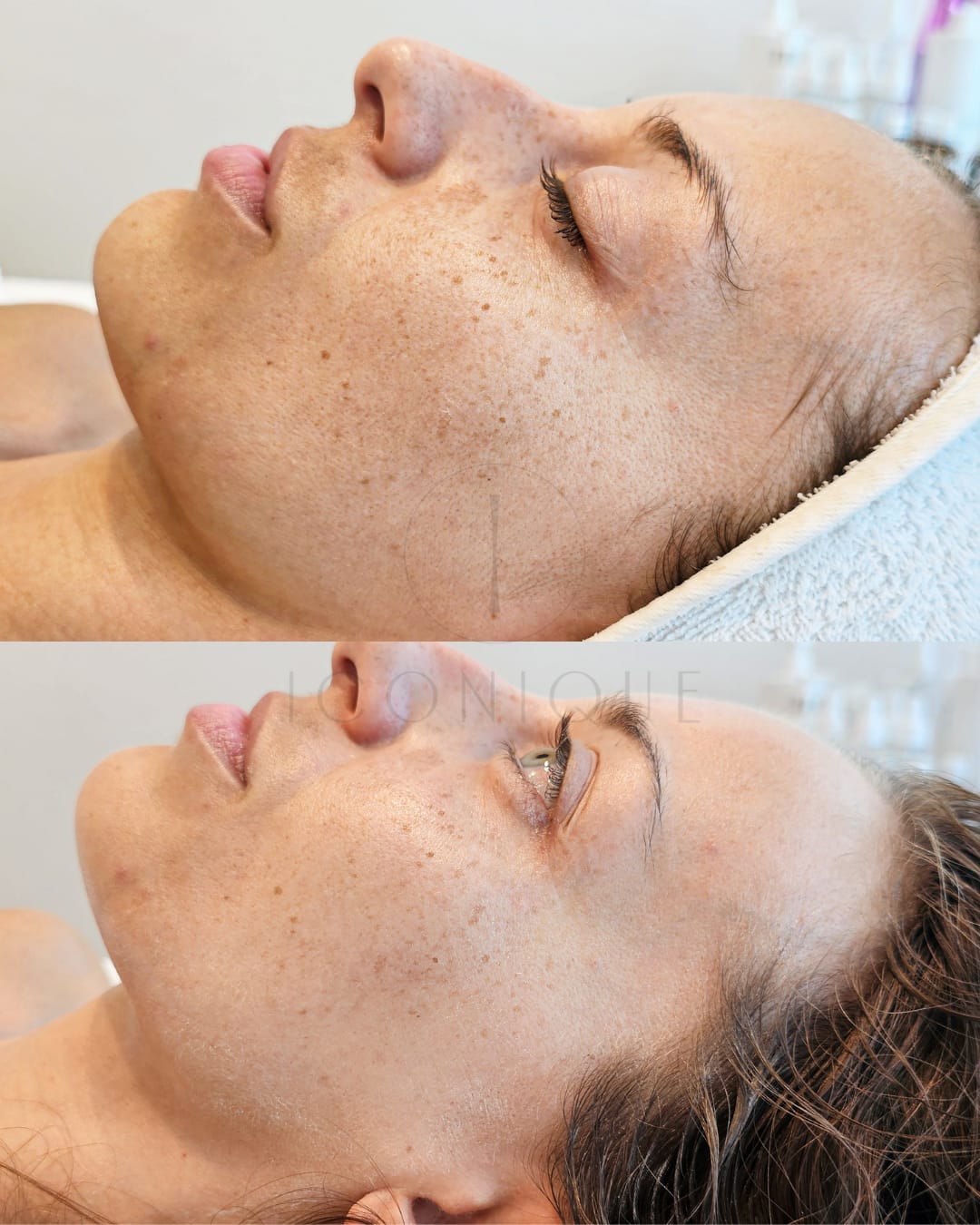 Risultato prima/dopo trattamento peeling chimico Iconique.