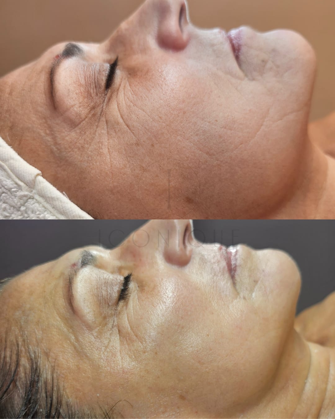 Risultato prima/dopo trattamento peeling chimico Iconique.
