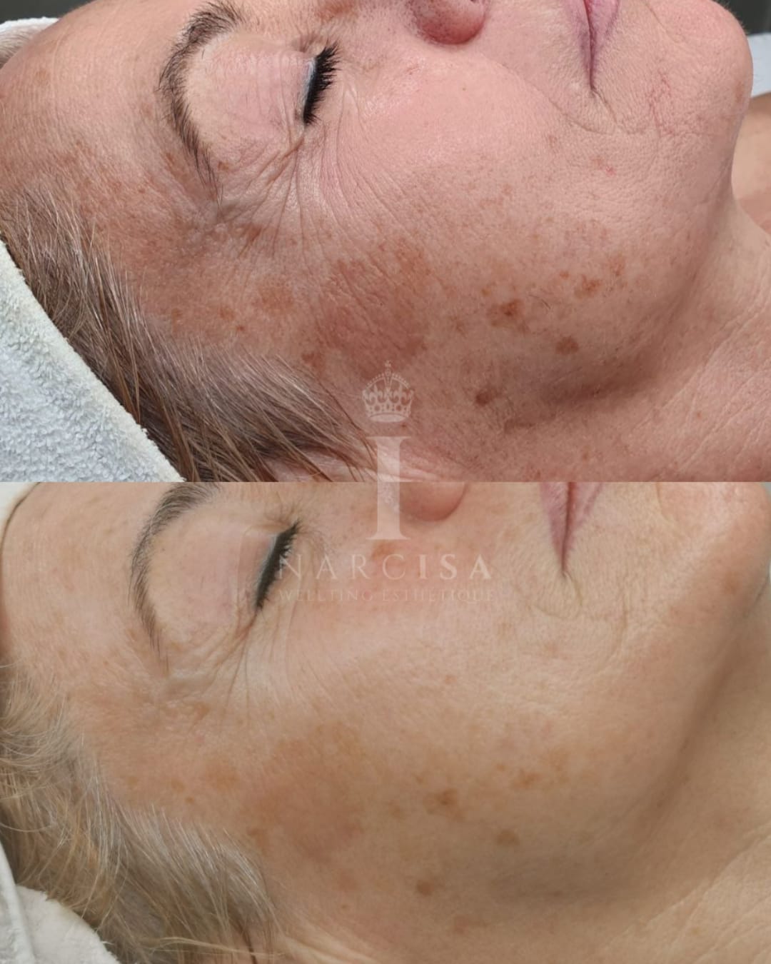 Risultato prima/dopo trattamento peeling chimico Iconique.
