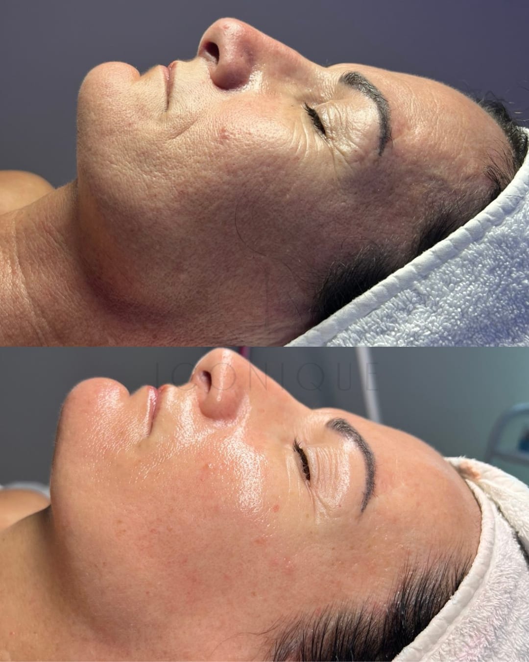 Risultato prima/dopo trattamento peeling chimico Iconique.