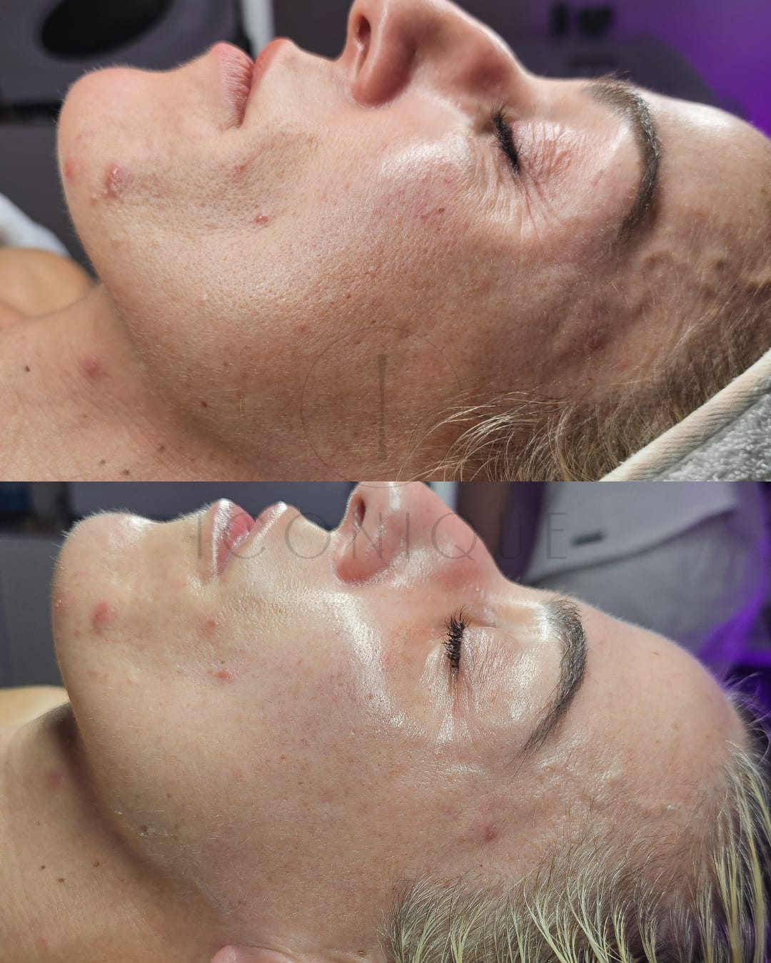 Risultato prima/dopo trattamento peeling chimico Iconique.