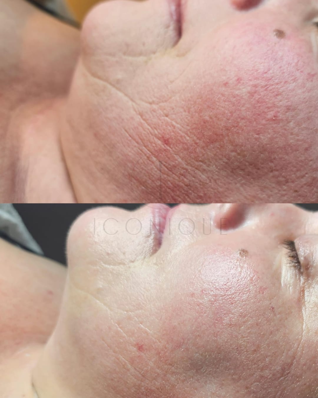 Risultato prima/dopo trattamento peeling chimico Iconique.