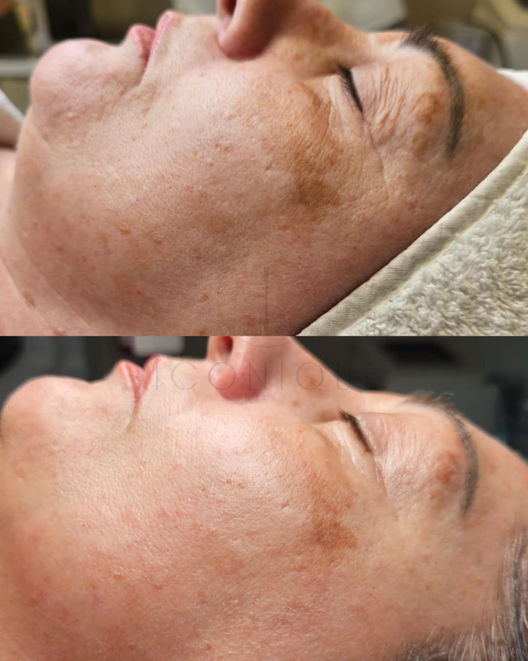 Risultato prima/dopo trattamento peeling chimico Iconique.