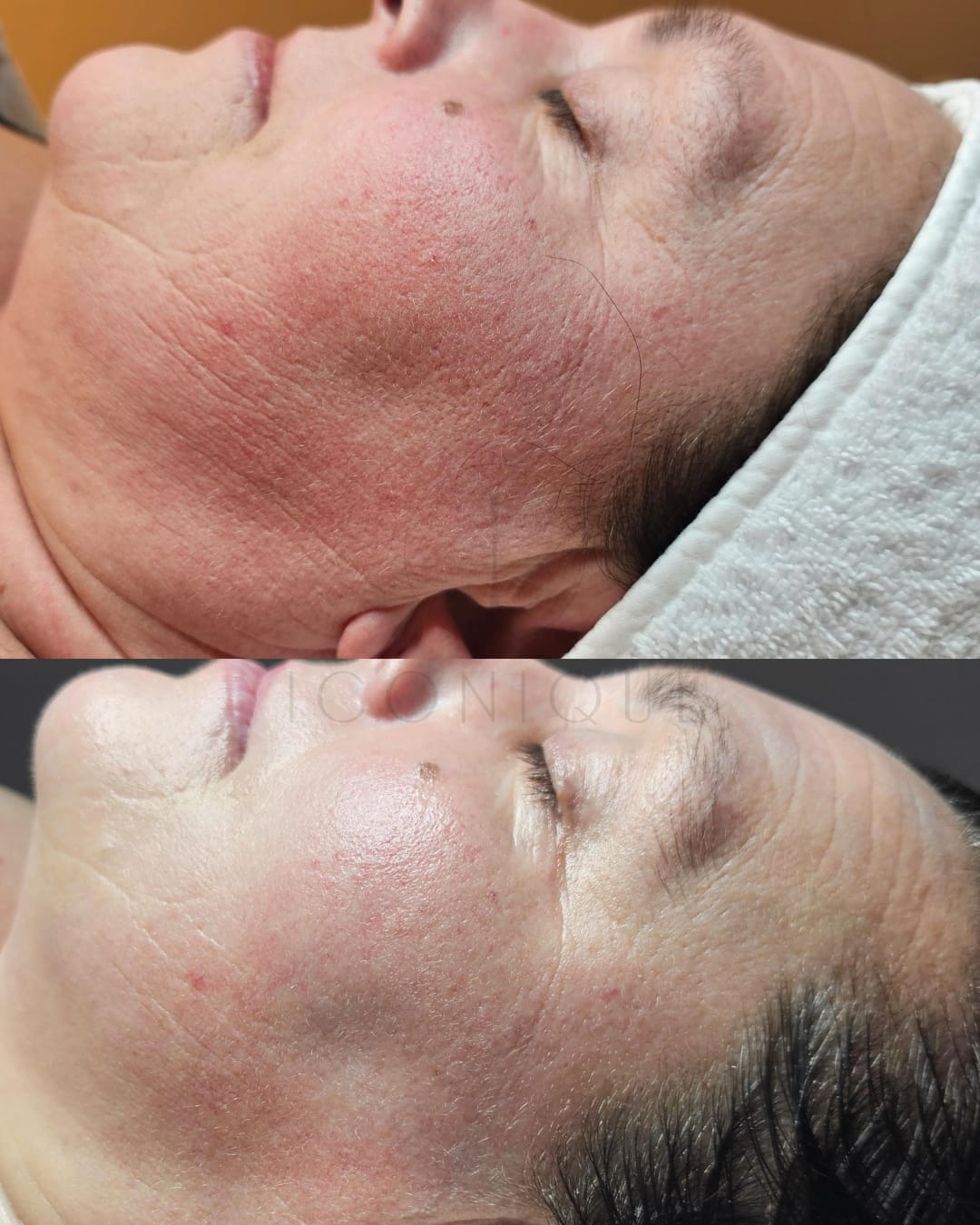 Risultato prima/dopo trattamento peeling chimico Iconique.