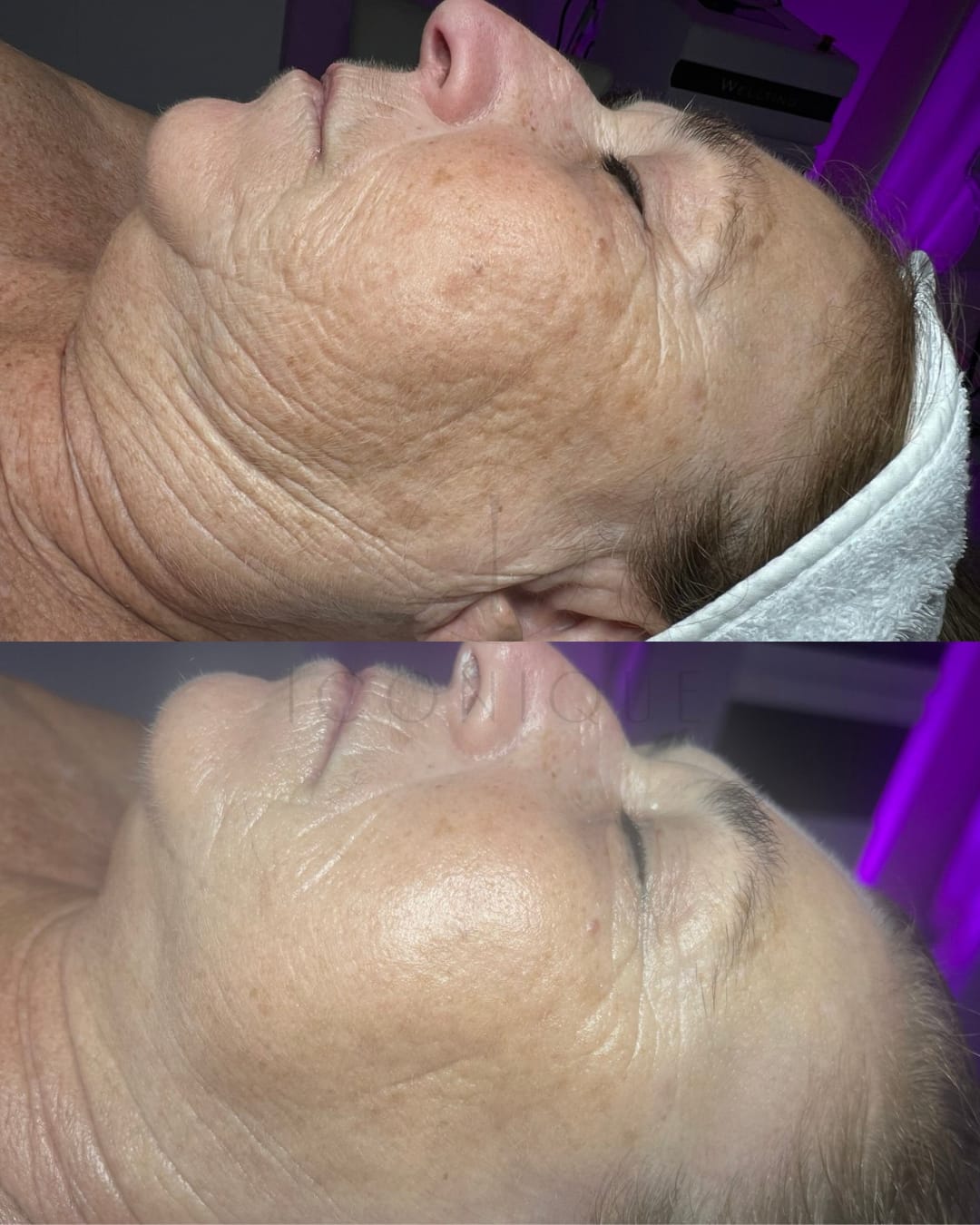 Risultato prima/dopo trattamento peeling chimico Iconique.