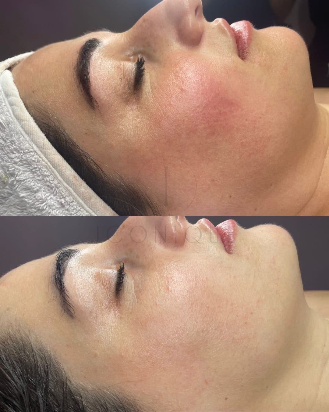 Risultato prima/dopo trattamento peeling chimico Iconique.