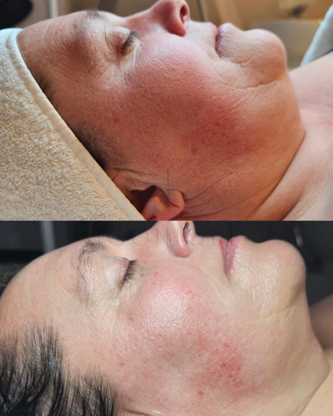 Risultato prima/dopo trattamento peeling chimico Iconique
