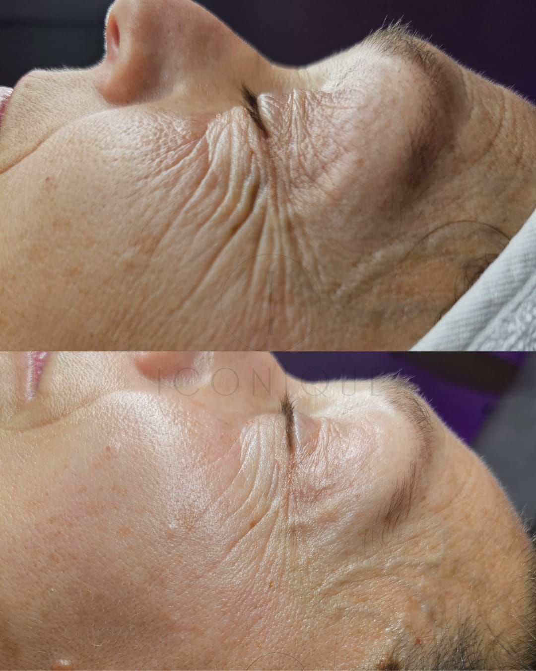 Risultato prima/dopo trattamento peeling chimico Iconique