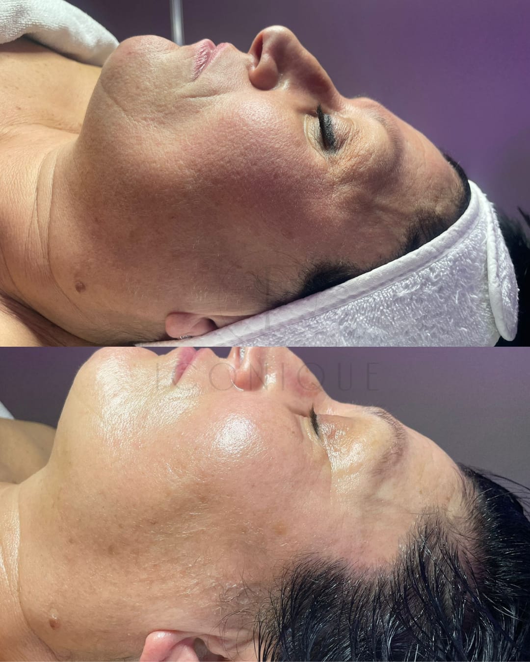 Risultato prima/dopo trattamento peeling chimico Iconique.