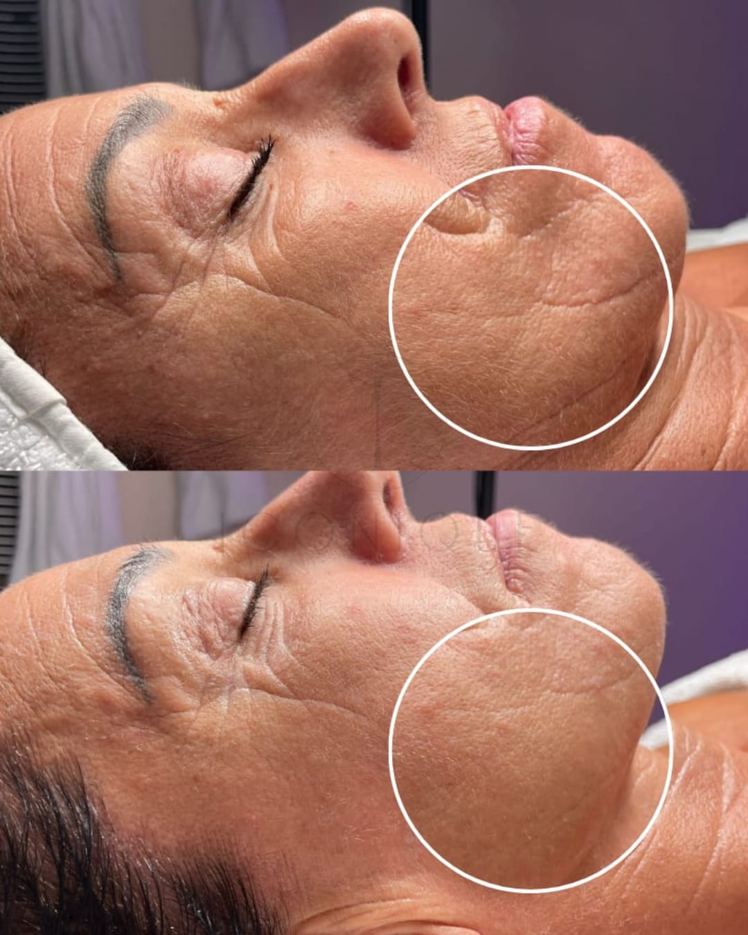 Risultato prima/dopo trattamento peeling chimico Iconique.